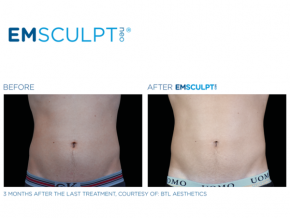 emsculpt